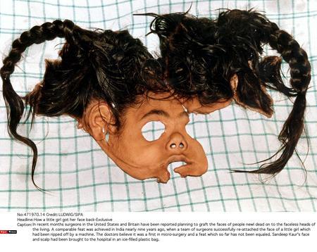 脱粒机撕掉女孩整个脸部 医生成功实施整形(图)