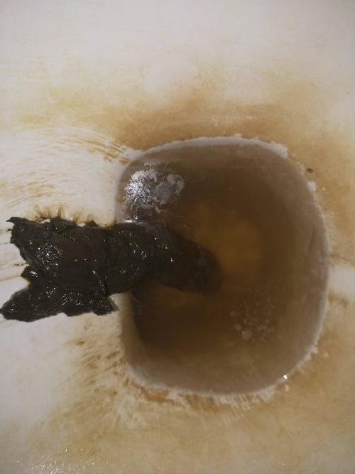 请问有谁知道这是不是黑便,上消化道出血的症状