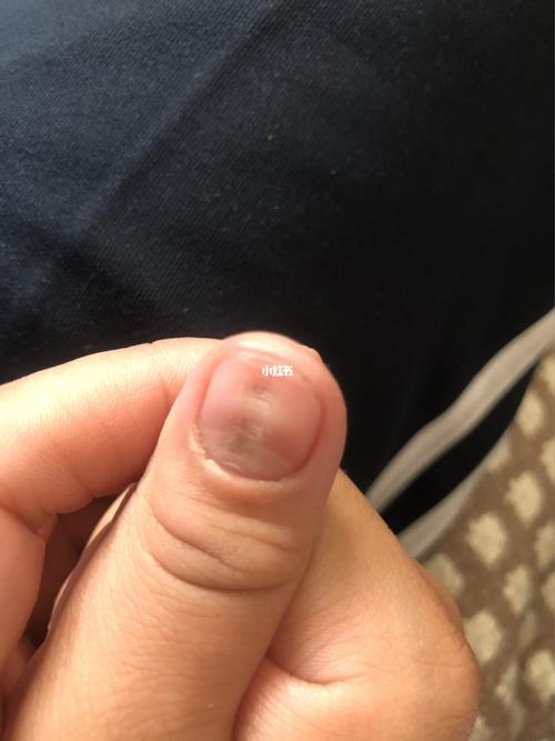 就两个手大拇指是这样的 中间凹陷 别的手指都没事  有人知道这是咋