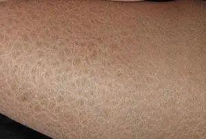 再看看自己,刚入秋,腿上就开始起干皮,本来光滑的肌肤变成了"枯树皮".