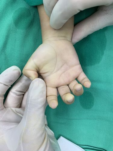 小儿狭窄性腱鞘炎大多数是先天性的,但是某些地方为了报销,我们都不写