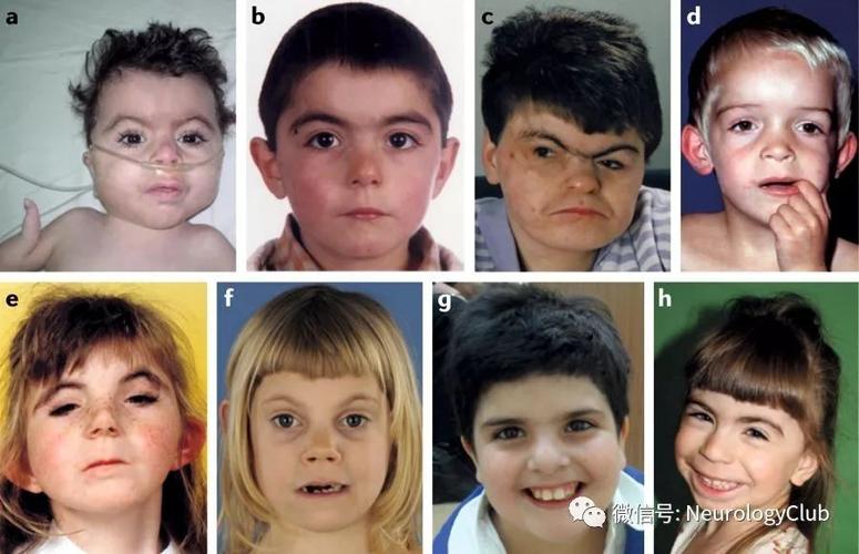神经病学综合征:cornelia de lange综合征_患者