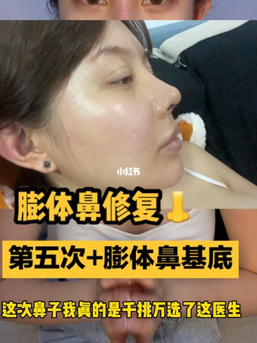 我第五次的膨体鼻修复 膨体鼻基底 第五天_北京自由行