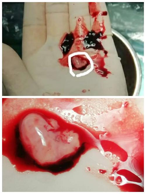 病灶中可见活的胚胎,已成形.掌心里白色的海马样小人儿就是胎芽.