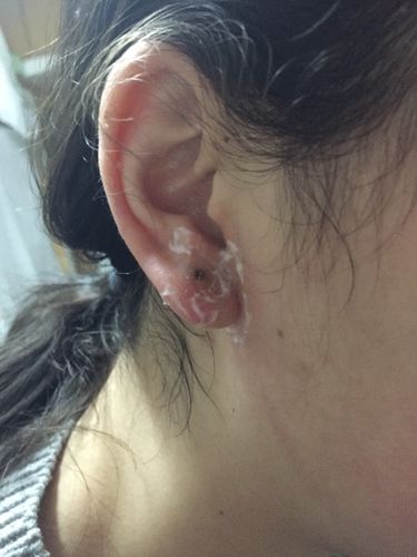 耳洞化脓,周围起皮,带了茶叶棒之后起皮的地方变得黑黄黑黄的,但是