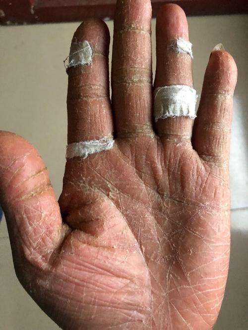 老爸早年手染过脚气,好了很多年,一到冬天就干裂脱皮