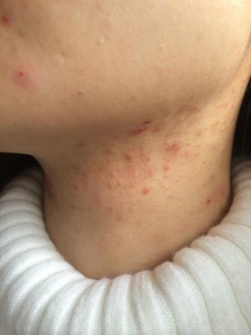 求救啊!最近几个月脖子上长了好多痘痘,不知道啥原因,越来越严重.