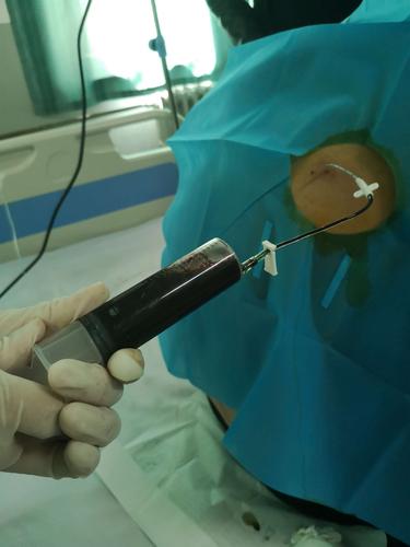 术中我科邵平乐医生经超声引导下反复定位,确定最佳进针位置,经穿刺