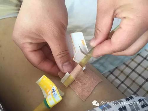 云南省肿瘤医院管道护理专科小组管道固定方式(二)