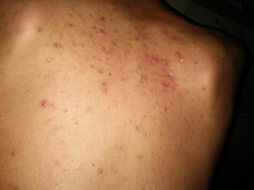 身体后背起痘痘是怎么回事?该怎么办?