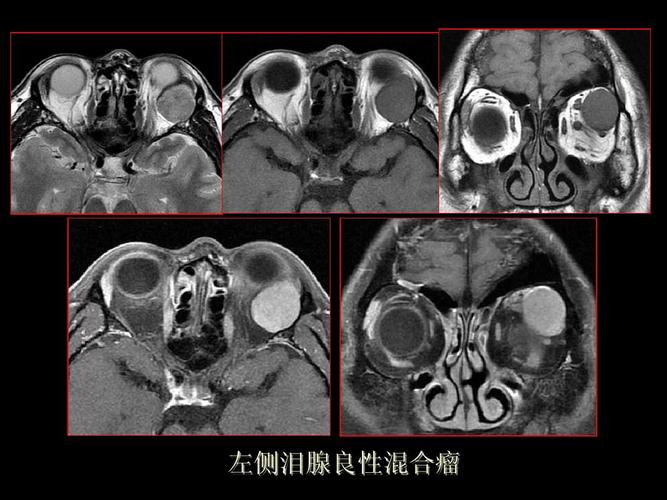 泪腺肿瘤及肿瘤样病变的影像学诊断 王振常ppt