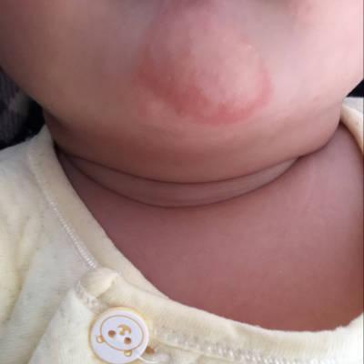 谁知道宝宝的下巴为什么会这样,很红而且都是小疙瘩,吃奶的时候更厉害