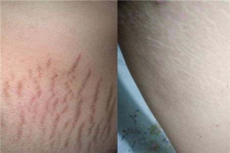 生长纹和肥胖纹的区别 教你简单辨别不同