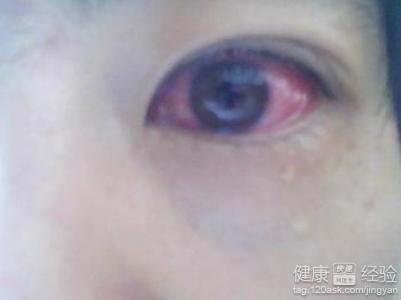 眼红,畏光等症状,患者是很难受的,所以要早发现,早治疗,角膜炎是指