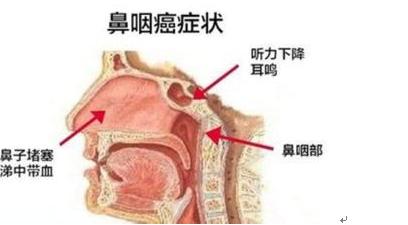 首页> 癌症预防 > 正文    鼻涕带血是鼻咽癌早期的常见表现,常发生在
