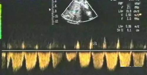 多图案例:胎儿宫内窘迫缺氧的超声诊断,这些要点你掌握了吗?