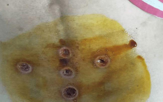 玉林这家无证诊所致患者皮肤溃烂!良心何在?