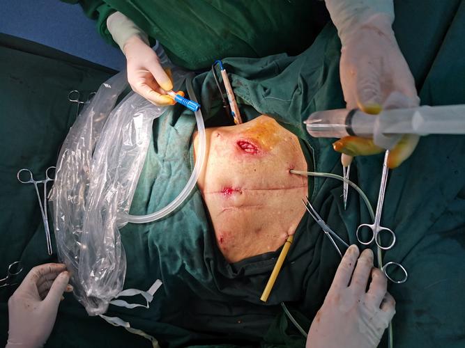 今日患者及家属要求,于全麻行腹腔镜下结肠造口回纳术,因上次手术