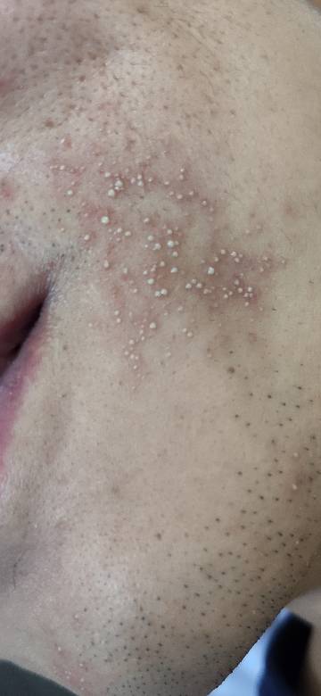 胆囊炎住院三天,脸上长了小颗粒,大神帮我看看这是皮癣吗