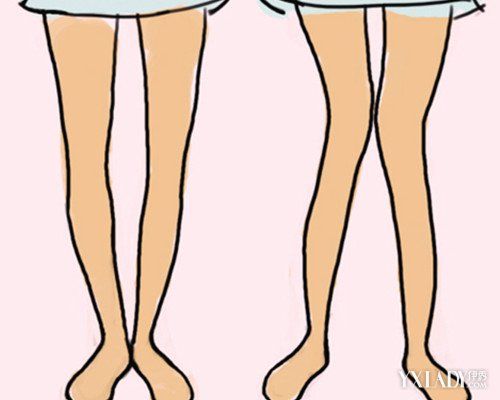 【图】内八字脚图片展示 五种训练方法让你轻松摆脱