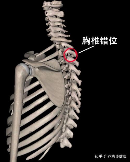 胸椎小关节紊乱