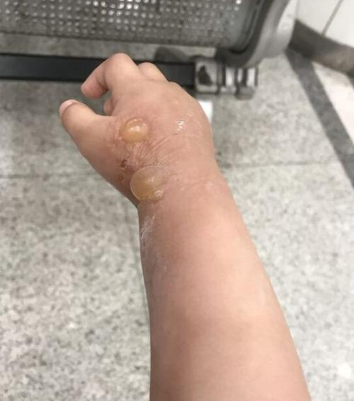 隐翅虫咬人后图片