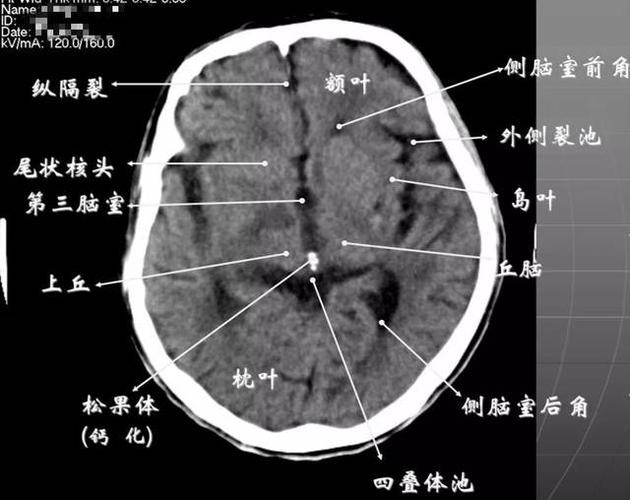 ① 显示侧脑室前角的下部:前方---额叶;外侧---尾状核头部;后方中线