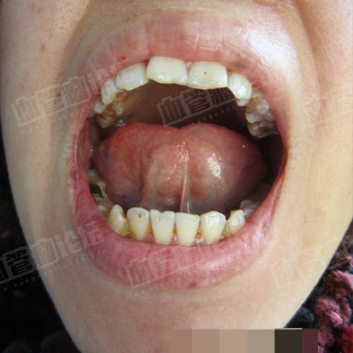 来自 刘*冬(成人)-口腔(舌)-血管畸形(淋巴血管瘤) 患者日记