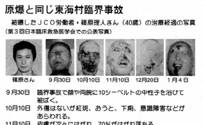 83天的核事故救治, 他看着自己的身体腐烂成一具活尸