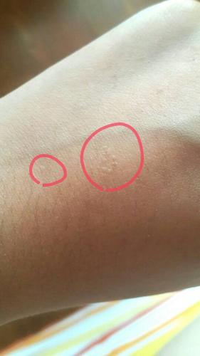 当时在手背和脚腕上数量也不少,当时医生说是扁平疣,做了冷冻,高中的