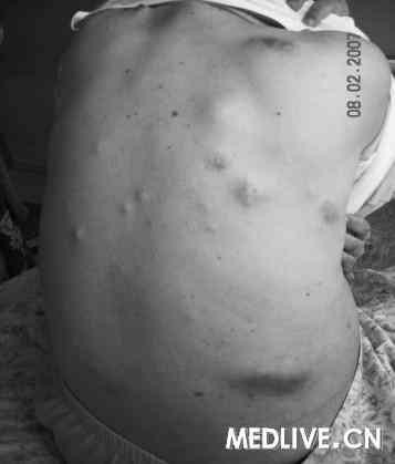 图1. 患者背部有多枚皮肤结节