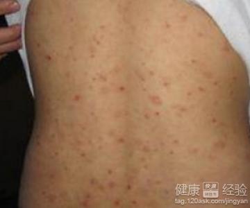 现在他们都知道疥疮的厉害了,开始去医院进行治疗皮肤科对于疥疮还是