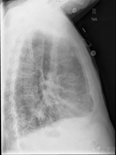 秒懂胸片扒一扒胸片的基础知识