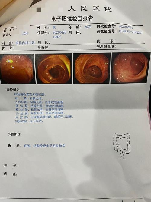 肠胃不好历经一个月的挣扎,我终于去做了普通肠镜