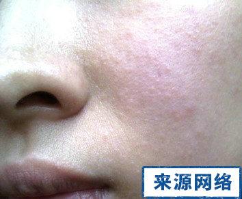 不同类型的过敏性皮炎症状图片