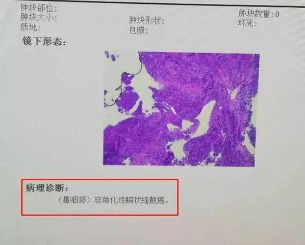 鼻咽部增强磁共振检查结果显示:鼻咽癌伴淋巴结转移;鼻内镜下鼻咽部