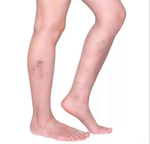 密密麻麻"蚯蚓腿",下肢静脉曲张的危害可不只是不美观