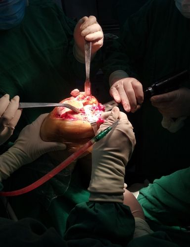 膝关节置换(七)施乐辉前篇