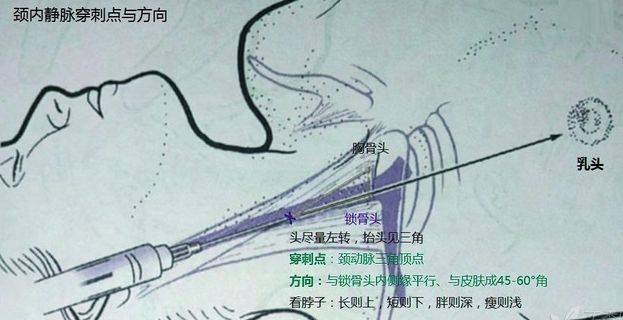 手把手教你颈内静脉穿刺术!(收藏版)