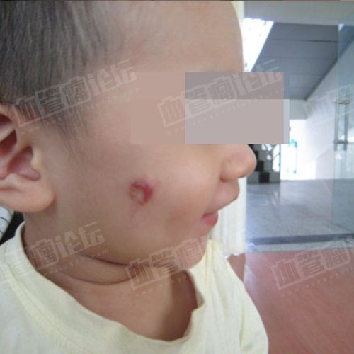 来自 闵*宇-面部-婴幼儿血管瘤(毛细血管瘤) 患者日记