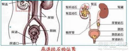 治疗尿道结石的特效药