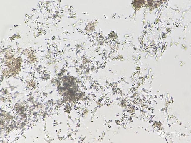 仅从形态方面分析,鼓槌样结晶可能是草酸钙结晶,硫酸钙结晶或磷酸钙
