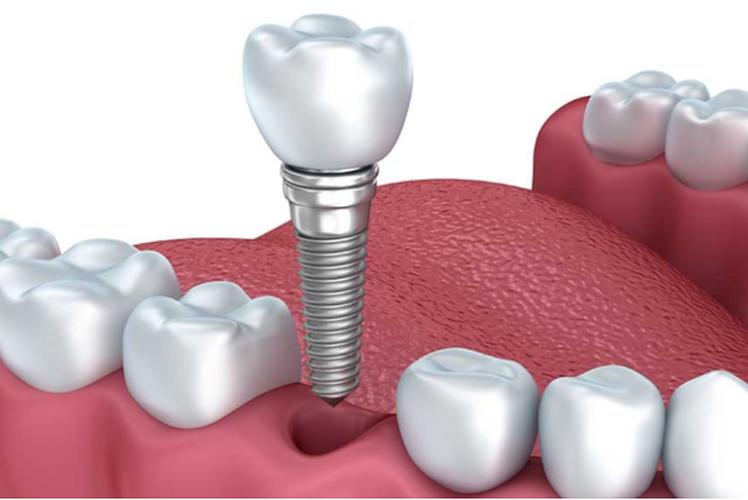 种植牙有年龄限制嘛