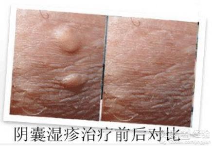 阴囊湿疹影响生育吗