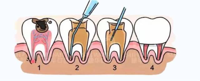 根管治疗拯救判死刑的牙齿