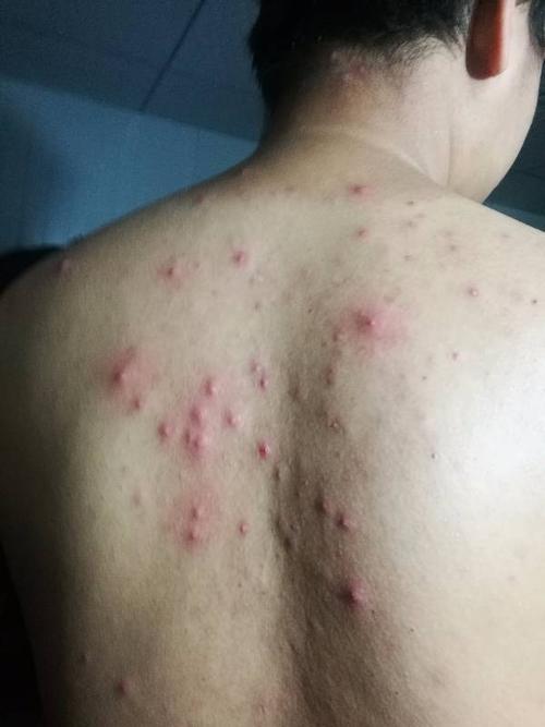 背上长痘,怎么办.
