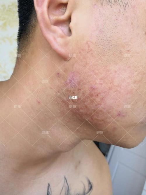 (疤康)这也太影响颜值了,治疗后帅呆_疤痕_成都疤康攻略_痤疮_炎症