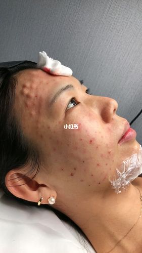 刚打完水光针,胆小慎入,其实不疼_水光针_美妆_医美