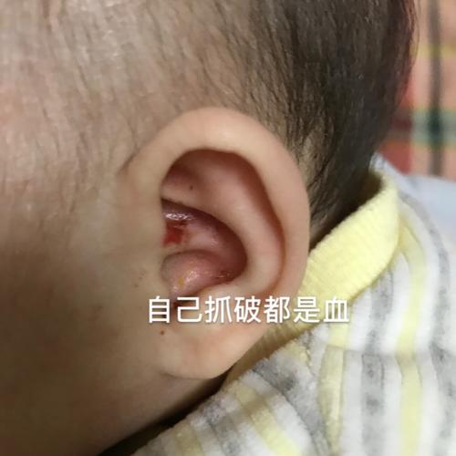 小宝宝频繁抓耳朵,当心外耳湿疹