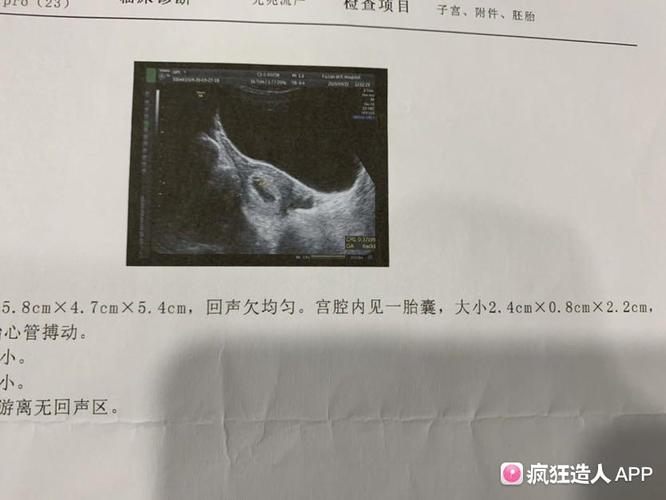 [试管婴儿]9周2又做了一次b超,孕囊变椭圆形了